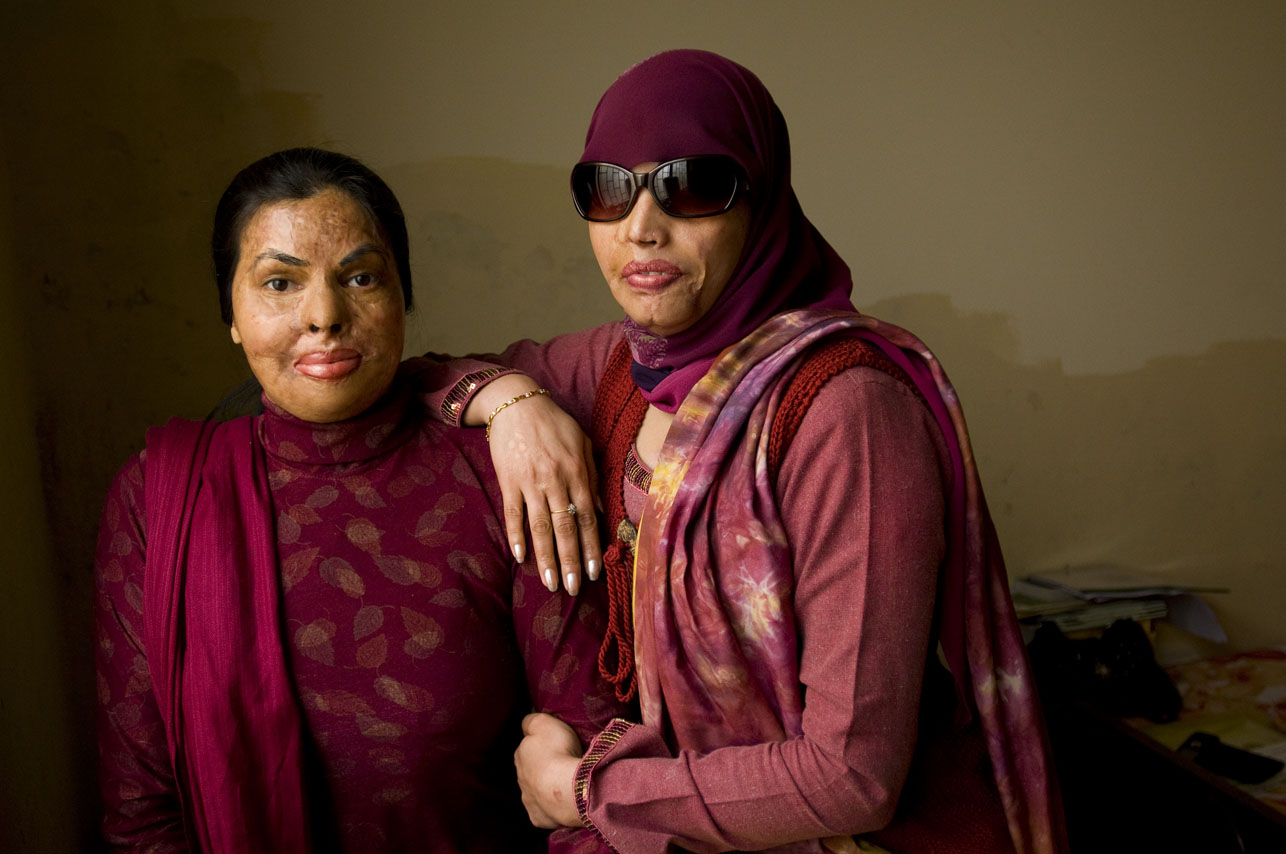 Sabira Manzoor(left), 31, and Iram Saeed (right), 30yrs, both burn victims and survivors, at Iram's mother's house in Rawalpindi, Pakistan on February 12, 2009.  Both women have received educational training and reconstructive surgeries from the Depilex Smile Again NGO.  I   There are presently over 300 cases of burn victims registered in Pakistan.  Most victims are between the ages of 14 - 25 years old.  Motives vary,  but are most frequently obsession, jealousy, suspected infidelity, husband wanting to re-marry, sexual non-cooperation.    The face and genitalia are the areas most generally targeted, those guaranteeing complete disfiguration.