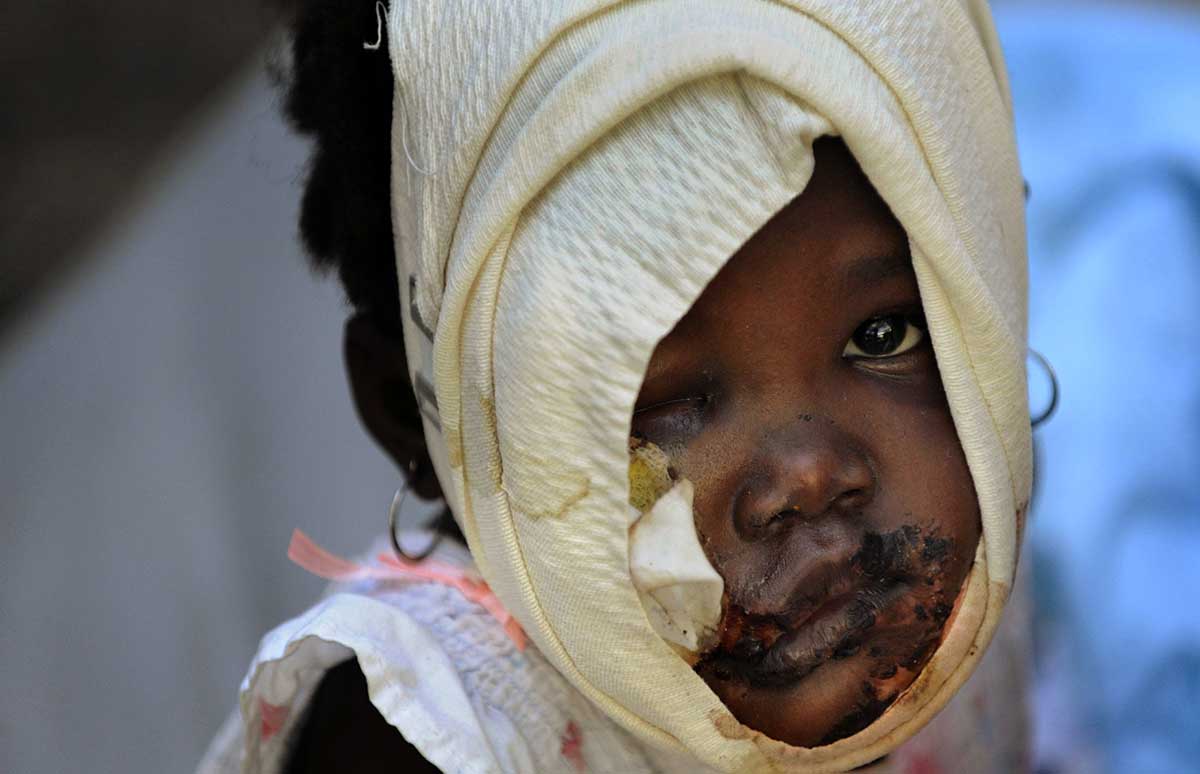 The battered and bandaged face of a child bears witness to serious injury sustained by the earthquake's victims as she sits at the General Hospital in Port-Au-Prince.  The overwhelmed facility is deluged with patients seeking care following the massive earthquake which devastated the impoverished country. © Nikki Kahn/The Washington Post 2010