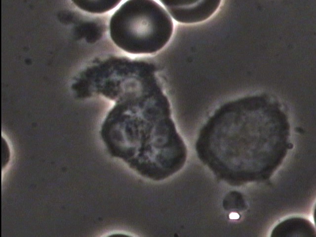 Su Sangre (para ver todas las imágenes, presione {quote}next{quote} debajo)Tomamos una gota de sangre de su dedo y la vemos bajo un microscopio.  Esto muestra los efectos de la acidez y alcalinidad en la sangre.  En esta foto vemos una célula roja en el tope, un neutrófilo en el centro y un linfocito a la derecha.  Estos 2 últimos son parte del sistema inmunológico.  En esta prueba se pueden ver bacterias, hongos, pedazos de colesterol, parásitos, el movimiento de células inmunes, entre otras cosas.  Es una manera rápida de ver los cambios en la sangre a medida que se va haciendo el programa y le enseña cómo se ve su sangre cuando se alcaliniza.