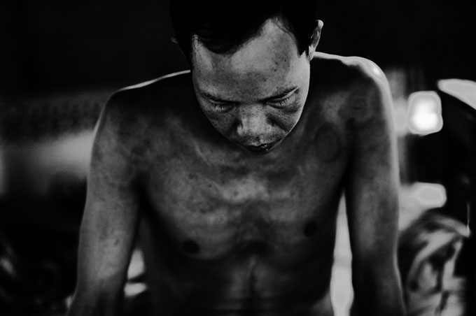 Siem Reap, December-2006: schizophrenic patient