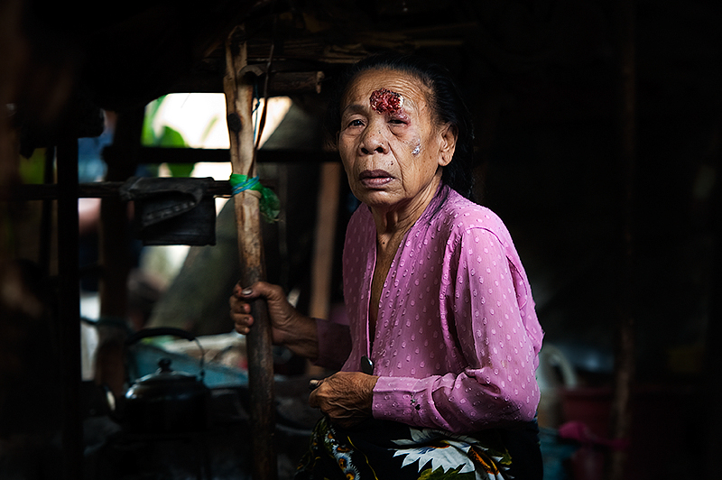 An elderly ethnic Moro woman with a cancer in her forehead is seen in front of her makeshift shelter in Datu Piang, IDP camp, Maguindanao