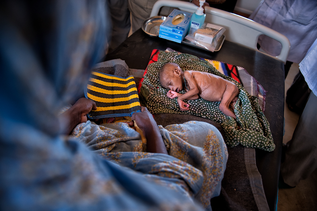 A 35 days old baby Lacuna, lays on the bed of the Medicines Sans Frontiers (MSF) clinic while attended by doctors in Mbera refugee camp.Lacuna was admitted to the clinical treatment of severe acute malnutrition and severe intestinal infection two days earlier. UNICEF in partnership with MSF In the Mbera refugee camp, the Nutrition survey carried out in November 2014 showed a significant decrease of both global acute malnutrition (from 11.8 to 9.9%) and severe acute malnutrition (1.4% to 0.8) rates. As of today, UNICEF has been supporting the government nutrition center in the treatment of 444 severe acute malnutrition (SAM) cases and contributed to the treatment of 790 other SAM cases. 