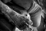 The foot of a homeless man is covered in sores and is testament of his hardships after loosing his leg in the military. With poor healthcare and little government assistance many victims are left to fend for themselves.(© Mike Brown)