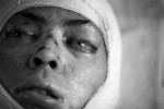 While Shawn is well into his recovery, his roommate Alvaro Llanos is still fighting for his life. Alvaro was burned over 58% of his body. Three months after the fire he stares aimlessly into space as he awakens from his coma, his eyes paritally sewn shut by the  doctors to protect his corneas. 