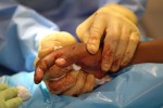 A surgeon holds the remainder of a 14-year-old boy's hand after amputating three gangrenous fingers.