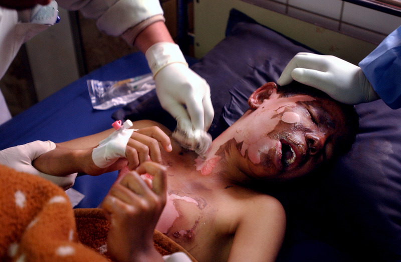 Husahm Ahmed, 12, screams as doctors remove dead skin from his face and neck after he was burned by a piece of unexploded munitions. Many children have been killed or maimed by playing with  unexploded ordnance that litters the ground. (Chris Schneider/EW Scripps)