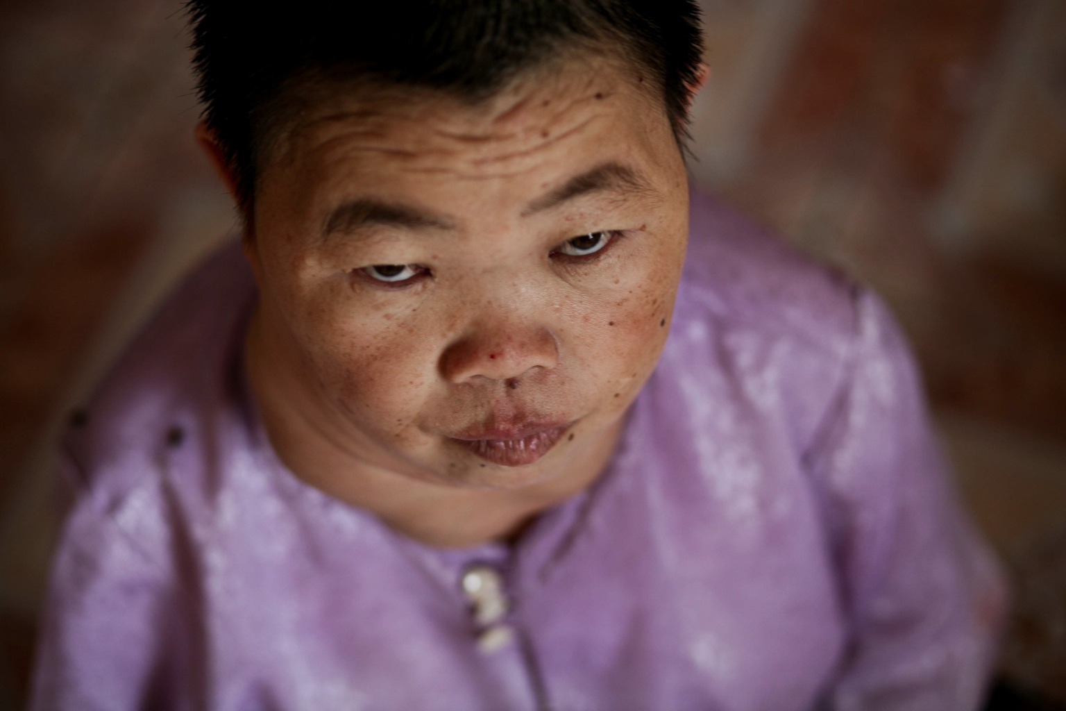 Agent Orange Victim, Thom Le Pham, gives a look of despair at home in the Benh Vien district, Vietnam.