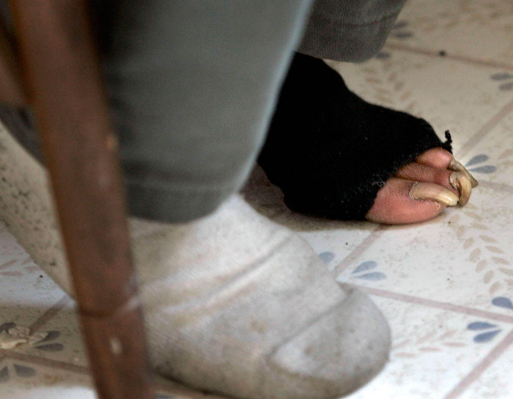 Debra Rhodes keeps one foot bare due to poor hygiene conditions, despite freezing temparatures inside the facility where she lives. Rhodes, who has schizophrenia, has a caseworker who visits her and is supposed to be monitoring her health.