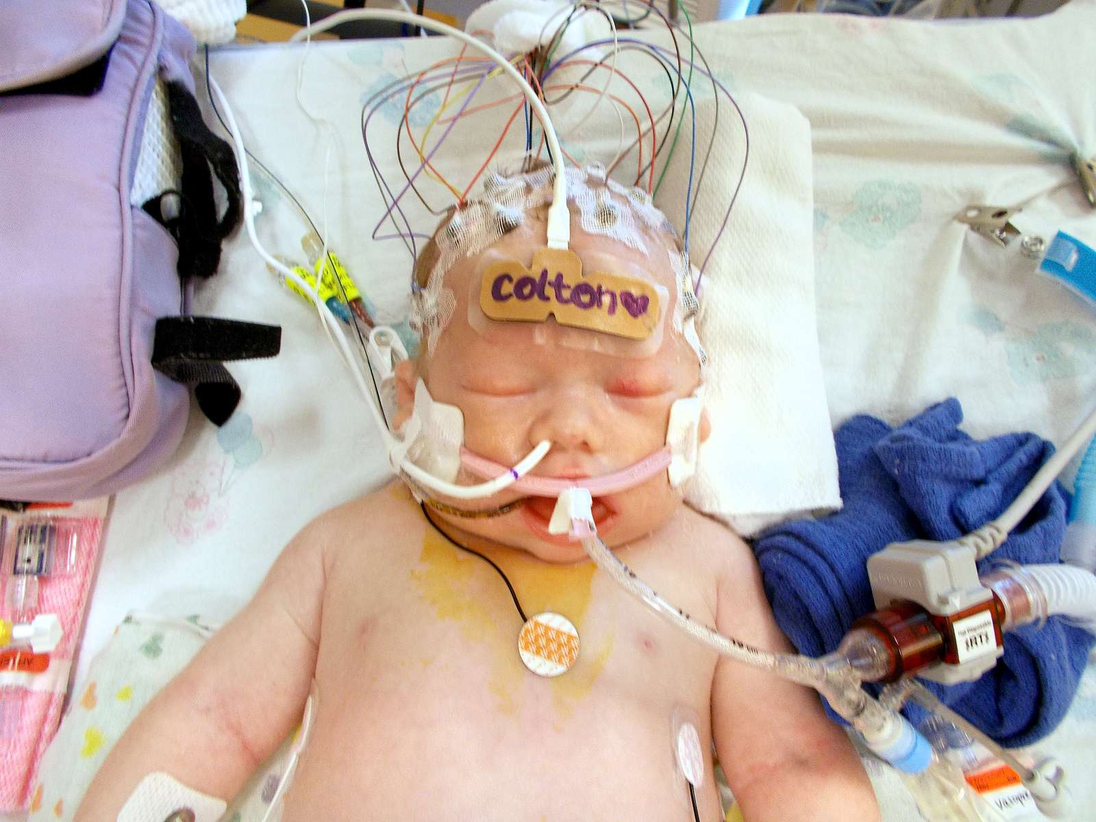 Colton Hidde arrived at Children’s Hospital of Wisconsin near death, with high ammonia levels in his blood. Doctors initially wrestled with whether he could be saved. it was a crisis that could have been avoided. 