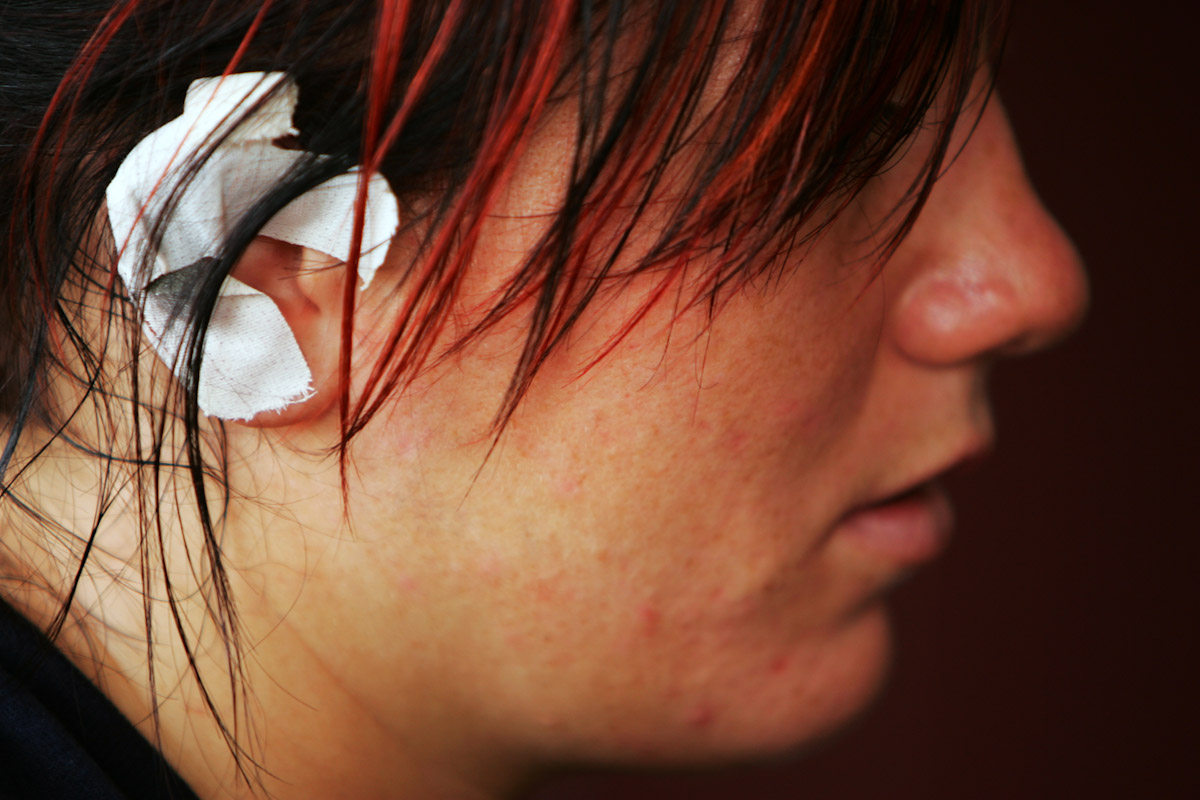 A view of the bandaged ear of training partner Kasi Lyle of the US Olympic Woman's Wrestling team at their training camp at Monsignor Farrell High School on June 24, 2004 in Staten Island, New York. 
