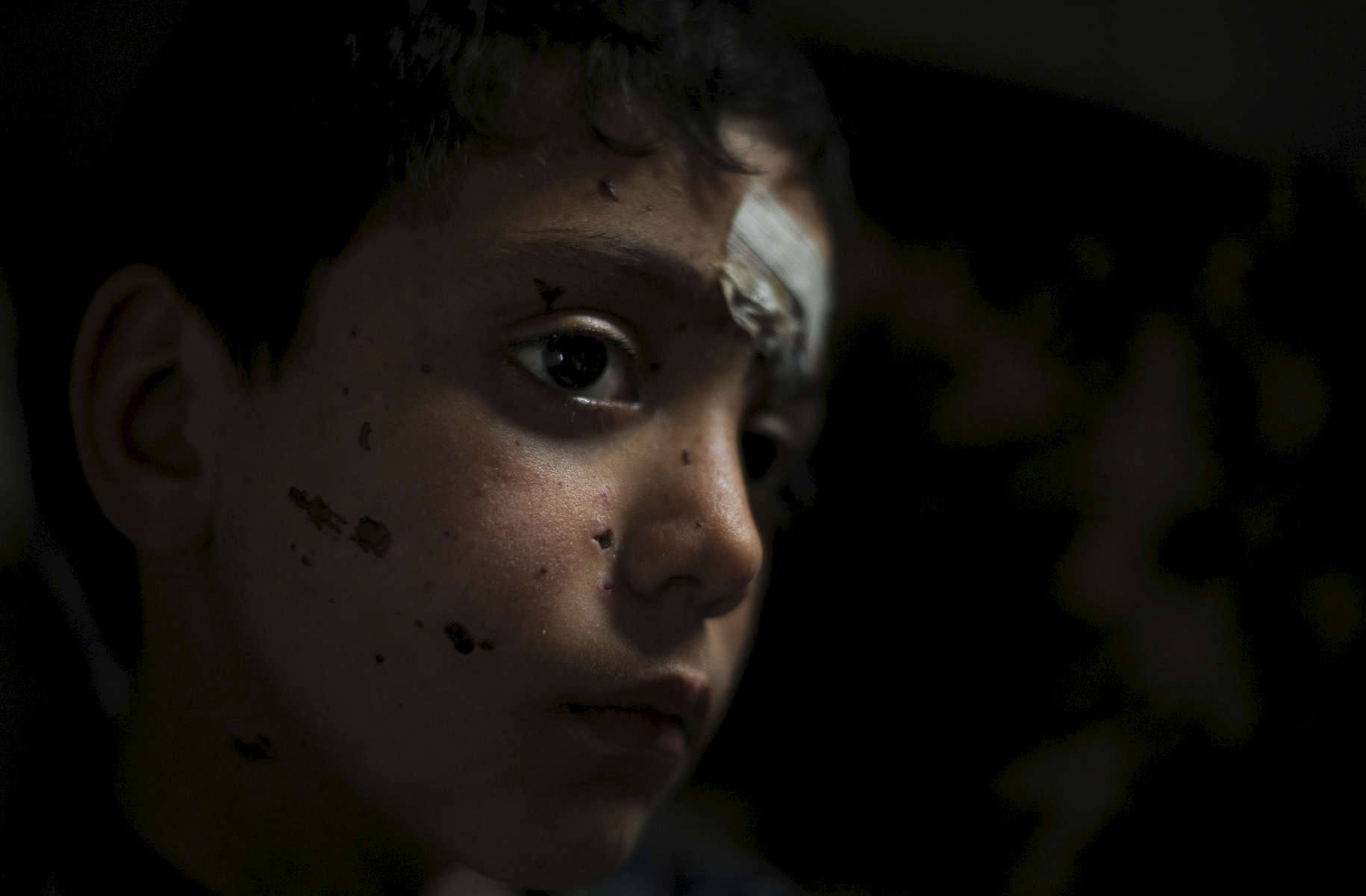 A nine year old Syrian child named Shadi was injured by shrapnel from an unidentified explosion while crossing the border to Lebanon. In the spring of 2012 there were less than 10,000 Syrian refugees registered in the country. By the end of the year that number had surged to more than 170,000. 