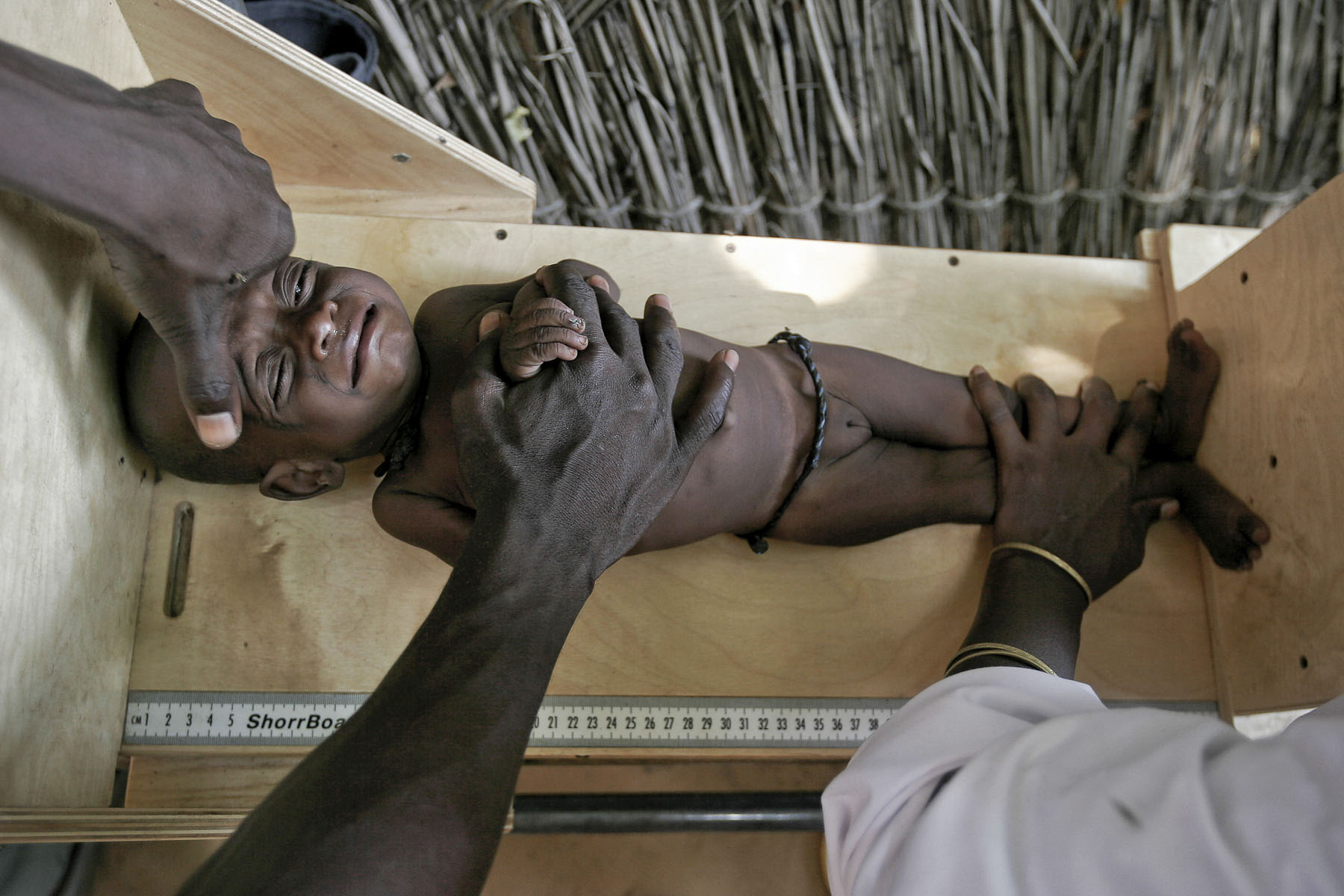 Children malnutrition detection in a MSF (Doctors Without Borders) center in September 2005