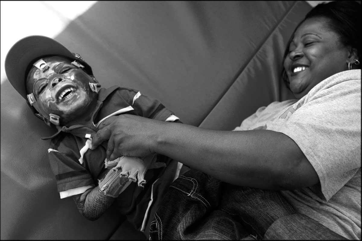Taquan Hawkins, 3, shares a laugh with his grandmother, Robin Richardson during his therapy. Taquan suffered burns to 75 percent of his body in an apartment fire. {quote}Sometimes, Taquan has bad days and sometimes, he has good days,{quote} Richardson says of her grandson, {quote}but I try to make his day the best.{quote}