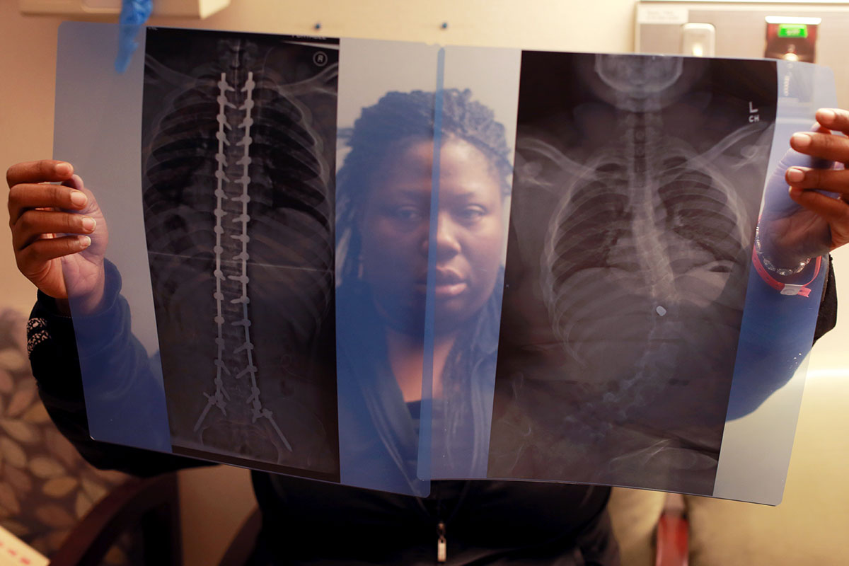 Lawanda Booker compares before (right) and after X-ray photos of Edward's spinal fusion surgery at Shriners Hospitals for Children in Philadelphia. A bullet on Edward's spine was also removed during the surgery. The hospital provided the surgery and other medical needs to Edward without a financial obligation. 