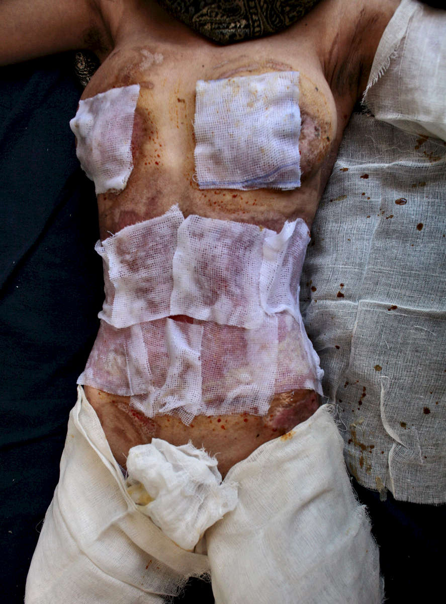 The burned body of a 22 year old a self immolation victim, lays on a bed at the Herat hospital November 16, 2006 in Herat, Afghanistan. Sima Gul complained that she was too lonely because her husband was forced to work in Iran to make money for her family. 