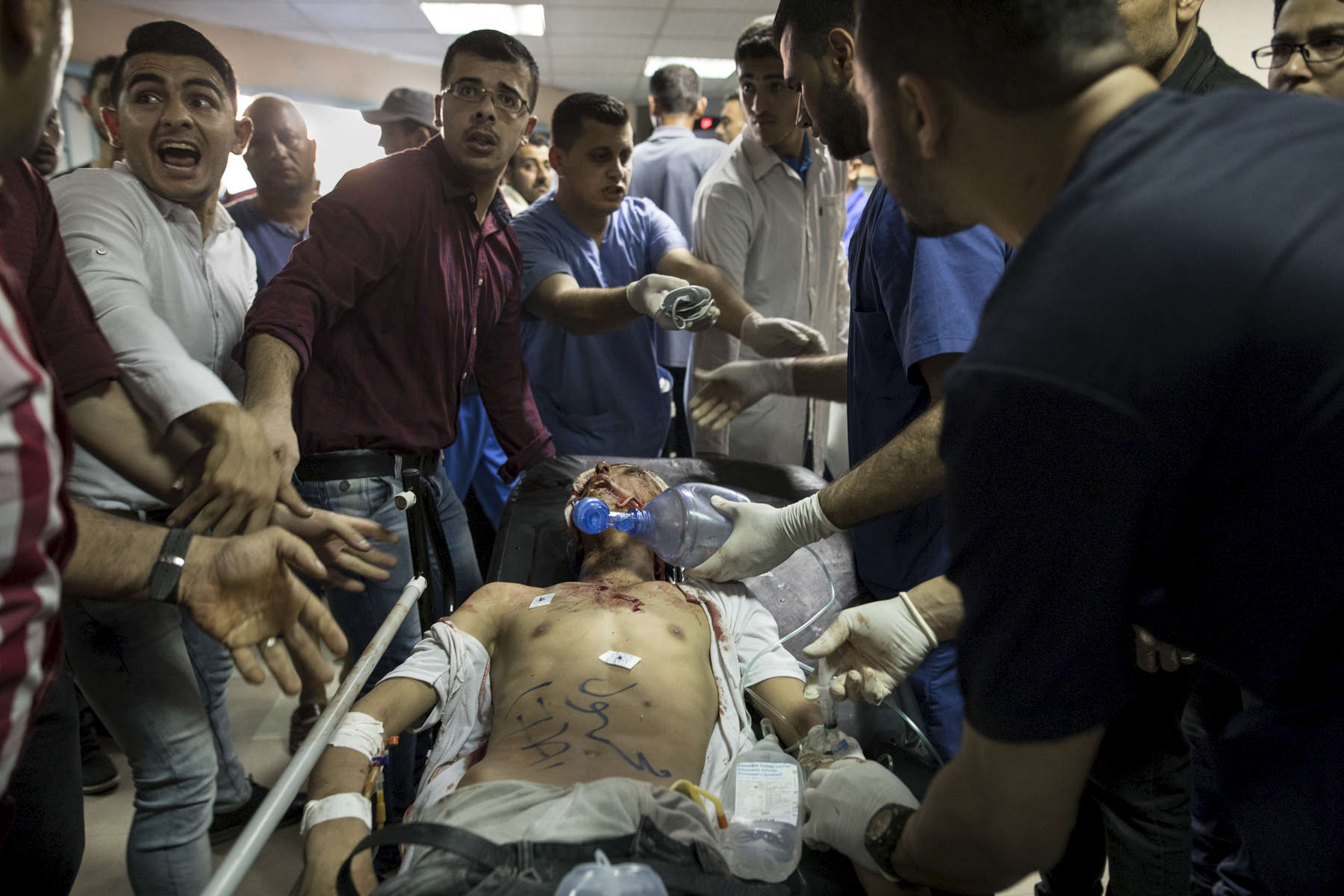 GAZA CITY, GAZA STRIP- MAY 14,2018:  A seriously injured male is seen being taken in for surgery at the emergency room at the Al Shifa hospital on May 14,2018 in Gaza city, Gaza strip. According to the International Committee of the Red Cross (ICRC), 13,000 Palestinians were wounded (as of June 19, 2018), the majority severely, with some 1,400 struck by three to five bullets. No Israelis were physically harmed during this time period, Israel's use of deadly force was condemned during the UN general assembly on June 13 th along with other human rights organizations. The Israeli military (IDF) started using new weaponry, explosive bullets that shatter bones, tissue, destroying veins and arteries, the aim is to create a handicapped community, especially amongst the young male population. Many of the wounded protesters have to undergo multiple surgeries to try to save their limbs, and in some cases amputation is the only solution. With limited healthcare available in Gaza many were sent to Jordan and Turkey for further treatment. More issues that plague Gaza include a water supply that is 95 percent contaminated and a population forced to live without electricity for 21 hours a day. Gaza is compared to Venezuela with almost half of it’s labor force unemployed. Everyone is well aware that Gaza's two million inhabitants are trapped in a cycle of violence and poverty, living in an open air prison. The problems and complications affecting Gaza today are overwhelming. The world, seemingly accustomed to the suffering of the Gazan people turns a blind eye. (Photo by Paula Bronstein ) 
