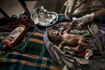 KUTUPALONG, BANGLADESH - KUTUPALONG, BANGLADESH - OCTOBER 4:  An severely malnourished, premature 15 day old baby gets treated in the pediatric - neonatal unit at the Kutupalong MSF clinic on October 4, Kutupalong, Cox's Bazar, Bangladesh. 