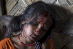 KUTUPALONG, BANGLADESH - OCTOBER 4: Aneta Begum,25,waits for treatment for a head injury after being attacked in the emergency unit at the Kutupalong MSF clinic on October 4, Kutupalong, Cox's Bazar, Bangladesh. Doctors Without Borders/Médecins Sans Frontières (MSF) has been providing comprehensive basic healthcare services at their Kutupalong clinic since 2009. Due to the current Rohingya crisis the clinic has expanded it's inpatient capacity dealing with approximately 2,500 out patient treatments and around 1,000 emergency room per week.   All healthcare services provided at the clinic are free of charge to both the Rohingya refugee population as well as local Bangladeshi patients. MSF has also set up a number of health posts, mobile clinics and water and sanitation services elsewhere in Cox‚Äôs Bazar to better respond to the influx. Well over a half a million Rohingya refugees have fled into Bangladesh since late August during the outbreak of violence in Rakhine state causing a humanitarian crisis in the region with continued challenges for aid agencies. (Photo by Paula Bronstein/Getty Images)