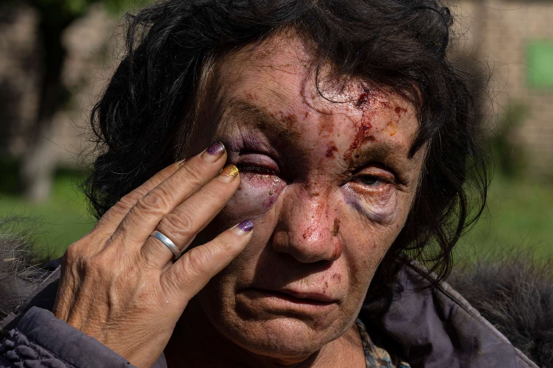 KRASNOTORKA, UKRAINE - Leda Buzinna, 56, stands outside her home, that was seriously damaged by shelling overnight when two S-300 missiles hit a rural neighborhood on October 4, 2022 outside of Kramatorsk district in Krasnotorka, Ukraine. Leda has facial injuries that were treated in a local hospital and she was released, her husband injured his leg in the attack. They have been living in the home for 18 years. They will get help for home repair from the government. Leda was sleeping when the missile hit their bedroom..(Photo by Paula Bronstein /Getty Images)