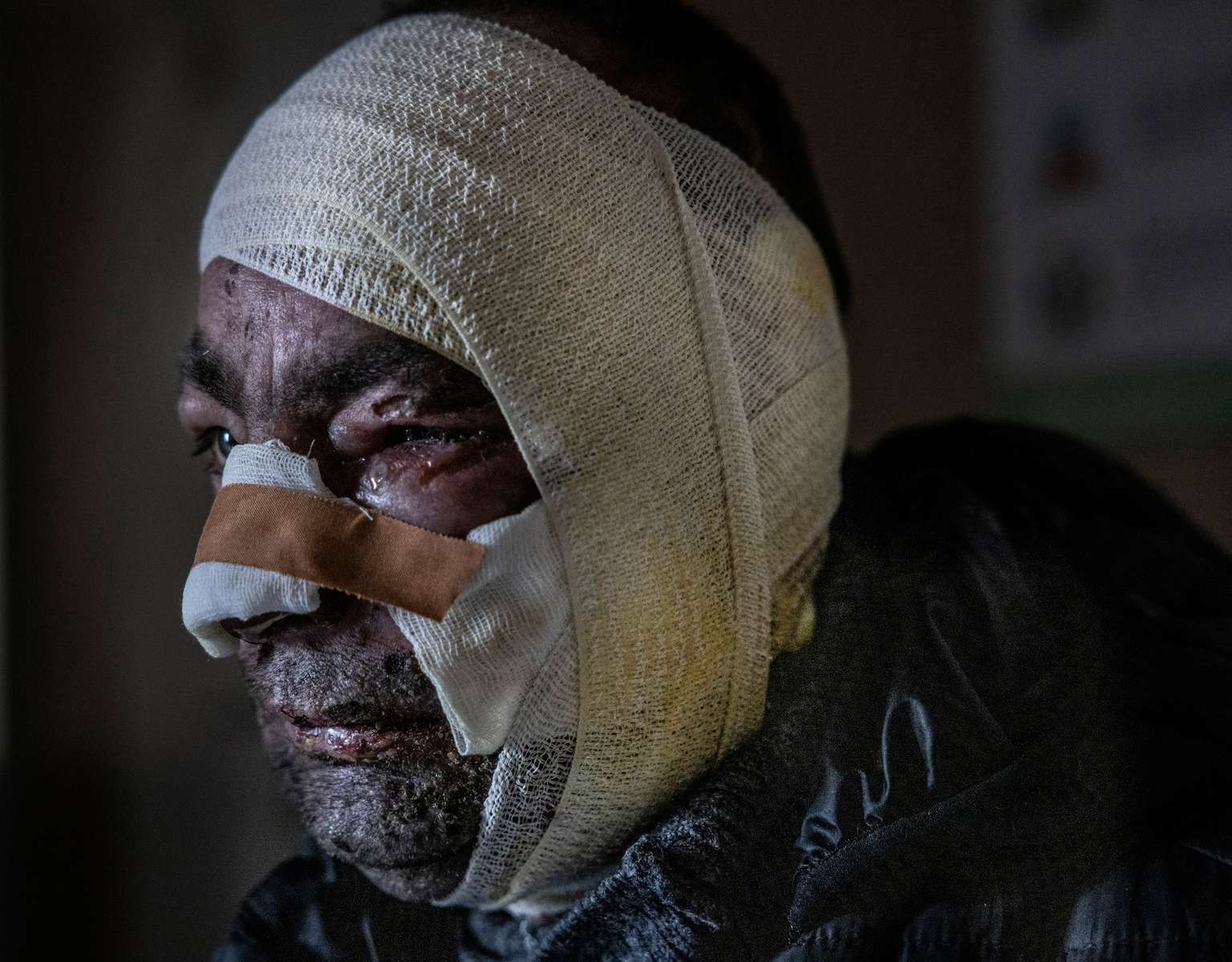 Viktor Zakharchuk is seen recovering at the Brovary hospital on March 19, 2022 he was injured when his home in Zalissya was shelled. The family hid in a neighbor’s home as the battle raged around them, they were eventually rescued and take to the Brovary general hospital.