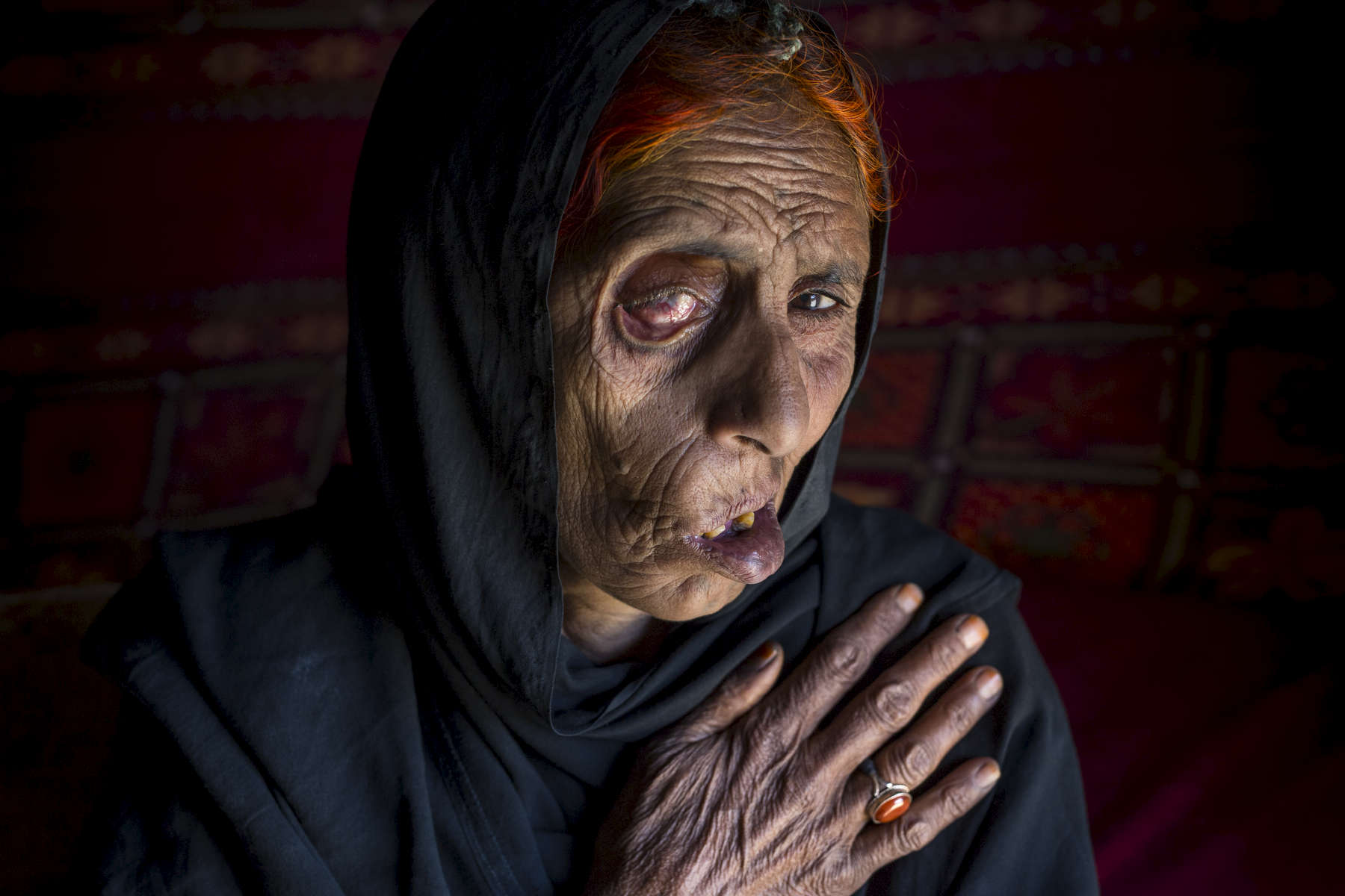 KABUL, AFGHANISTAN - APRIL 10, 2015:  Widow Naiz Bibi claims she is 68 but really can\'t remember clearly.  She has had a very hard life,  blinded in one eye she fled up north to the IDP camps of Kabul from the war torn province of Helmand. Naiz  barely survived after she lost 7 members of her family during a NATO air strike including her husband, daughter and 2 sons. The eight that survived  are now helping to take care of her since she is in bad health, living in the squalid Nasaji Bagrami camp outside of Kabul for thousands of war refugees. 