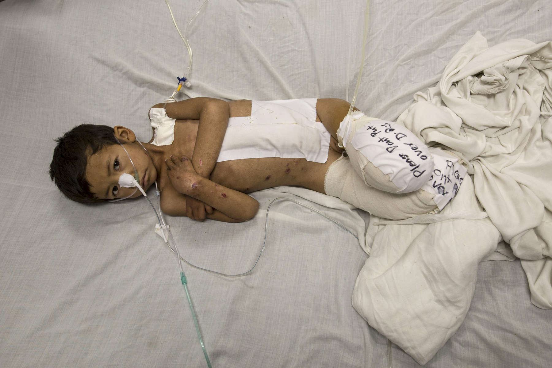 KABUL, AFGHANISTAN -APRIL 3, 2016: Kabir age 5, from Faryab lays in bed at the Emergency hospital in Kabul on April 3, 2016. He is a victim of a rocket attack, lost both of his legs along with his sister and brother who were also killed. Afghan civilians are at greater risk today than at any time since Taliban rule. According to UN statistics, in the first half of 2016 at least 1,600 people had died, and more than 3,500 people were injured, a 4 per cent increase in overall civilian causalities compared to the same period last year. The upsurge in violence has had devastating consequences for civilians, with suicide bombings and targeted attacks by the Taliban and other insurgents causing 70 percent of all civilian casualties.  