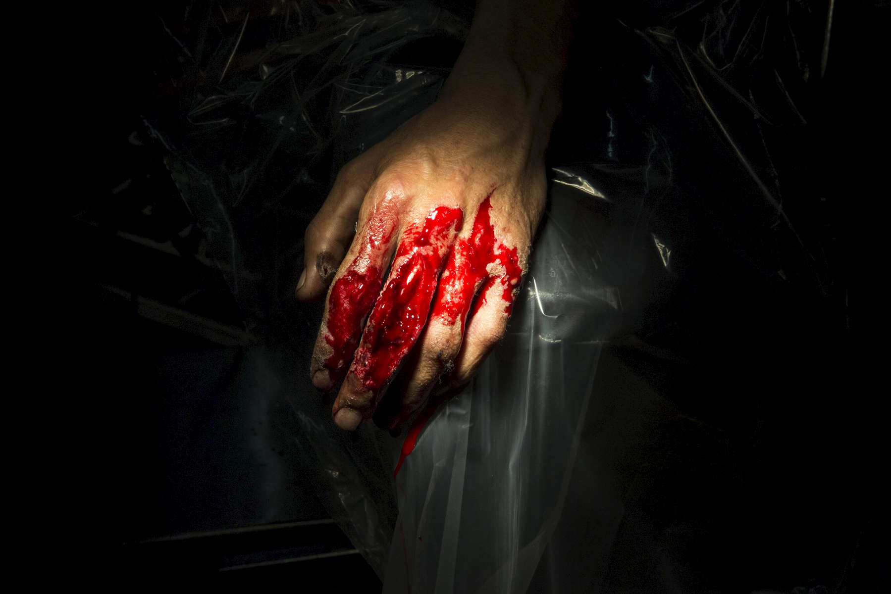 LASHKAR GAH, AFGHANISTAN -MARCH 26, 2015: A bloody hand is seen in the operation room at the Emergency hospital.  As of April, 2016 the Emergency hospital stated that in the first quarter their patient numbers were up more than 30% from last year.  Afghan civilians are at greater risk today than at any time since Taliban rule. According to UN statistics, in the first half of 2016 at least 1,600 people had died, and more than 3,500 people were injured, a 4 per cent increase in overall civilian causalities compared to the same period last year. The upsurge in violence has had devastating consequences for civilians, with suicide bombings and targeted attacks by the Taliban and other insurgents causing 70 percent of all civilian casualties.  