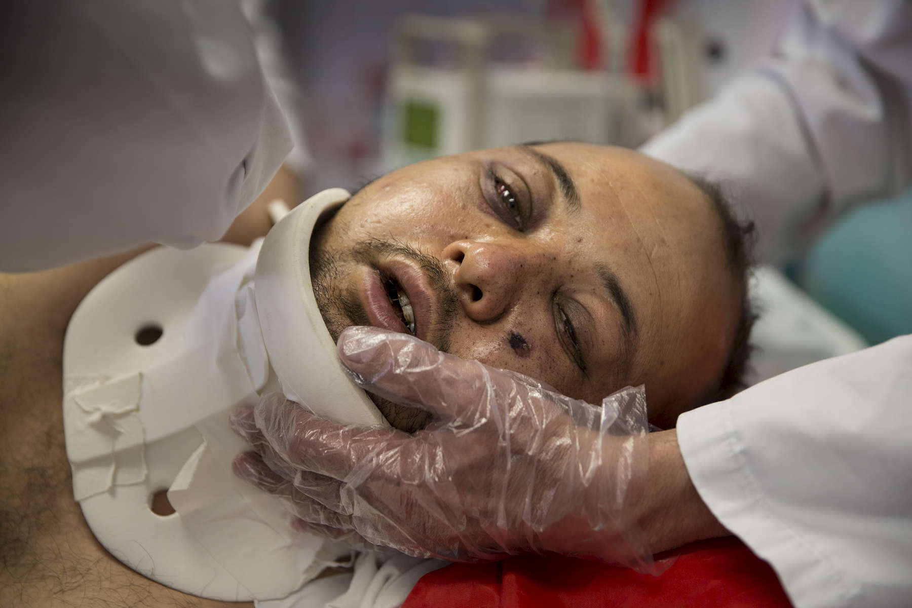 KABUL, AFGHANISTAN -MARCH 21, 2016: Azim, 25, a a quadriplegic who suffered bullet wounds to his face gets shifted to his side by medical staff at the Emergency hospital in Kabul on March 21, 2016. Every year the UN comes out with their report documenting the unfortunate carnage from America’s longest and most costly war in history. Along with the price tag estimated in the hundreds of billions, the human toll from a 2015 UN Assistance Mission To Afghanistan (UNAMA) report stated the number of Afghan civilians killed and wounded surpassed 11,000.  which was the deadliest on record for civilians in Afghanistan since the US-led invasion more than 14 years ago. 