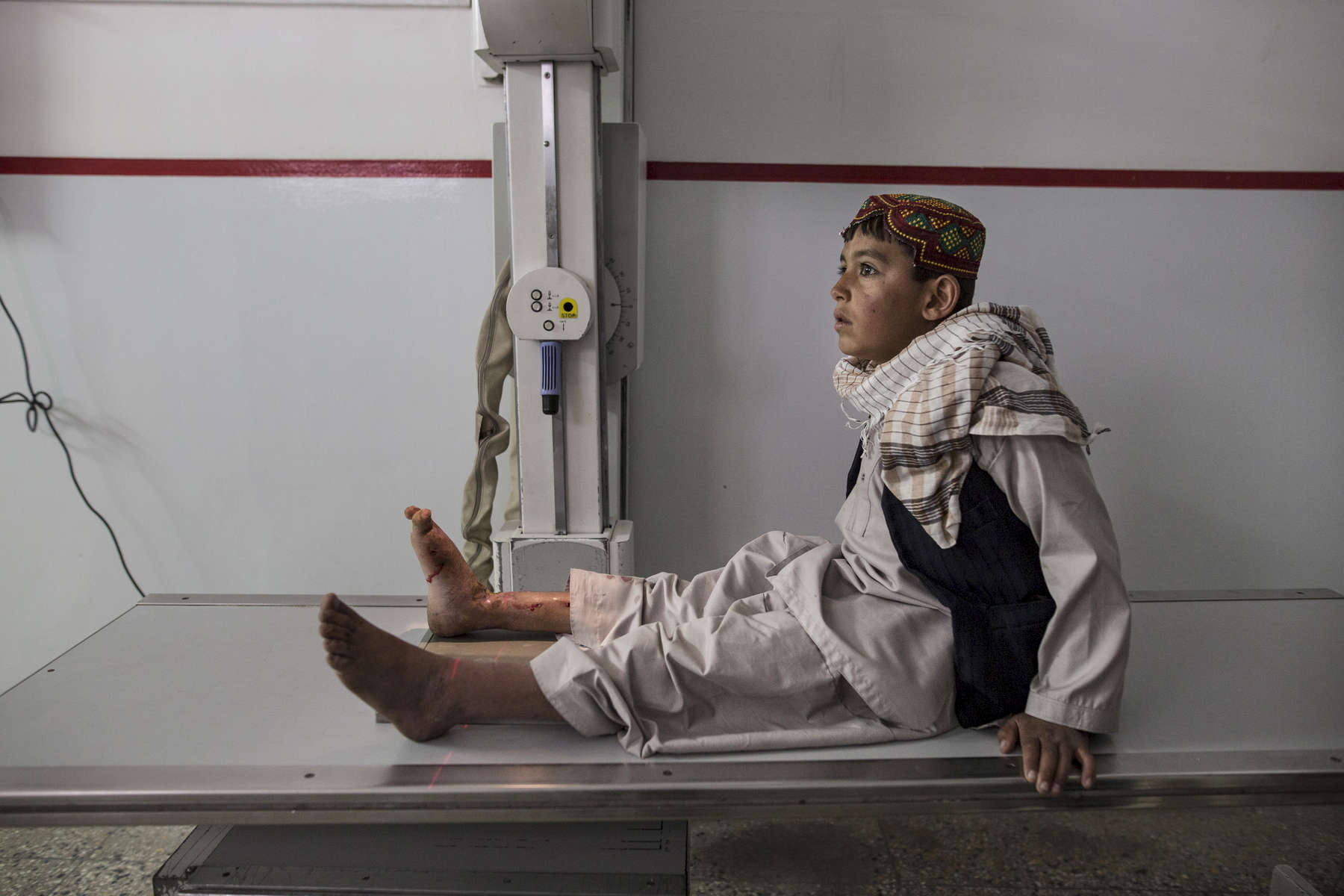 KABUL, AFGHANISTAN -MARCH 29, 2016:  At the Emergency hospital a Pashtun boy waits for an X-ray on his leg from a mine injury in Kabul on March 29, 2016. Every year the UN comes out with their report documenting the unfortunate carnage from America’s longest and most costly war in history. Along with the price tag estimated in the hundreds of billions, the human toll from a 2015 UN Assistance Mission To Afghanistan (UNAMA) report stated the number of Afghan civilians killed and wounded surpassed 11,000.  which was the deadliest on record for civilians in Afghanistan since the US-led invasion more than 14 years ago. 